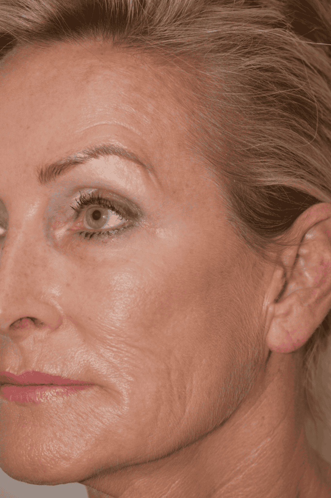 Frau erhält Eigenbluttherapie zur Hautverjüngung, natürliche Anti-Aging-Behandlung.