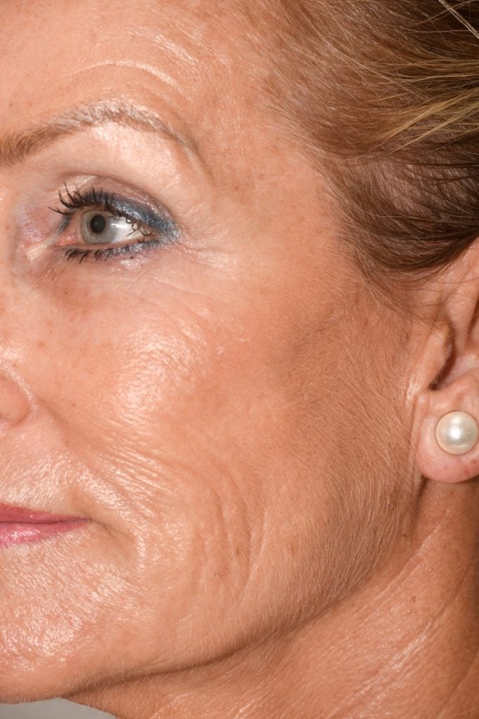 Hautverjüngung mit PRP / IPRF Eigenbluttherapie für jüngeres Aussehen.