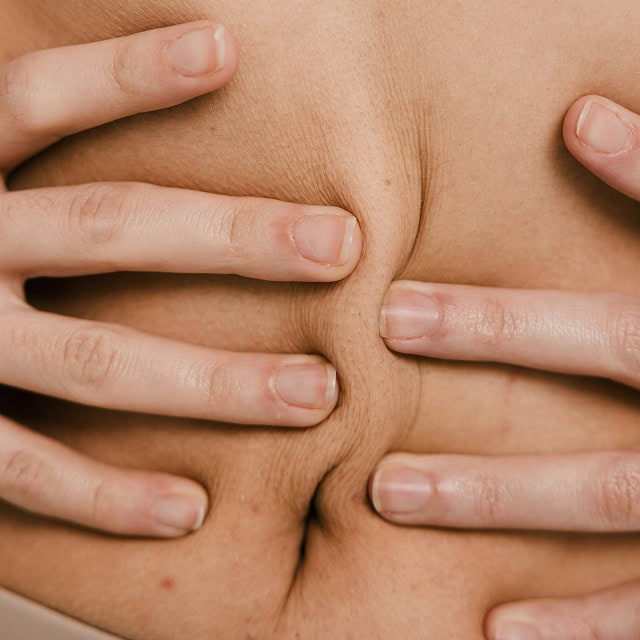 Hautstraffung am Bauch mit Hautfalten.